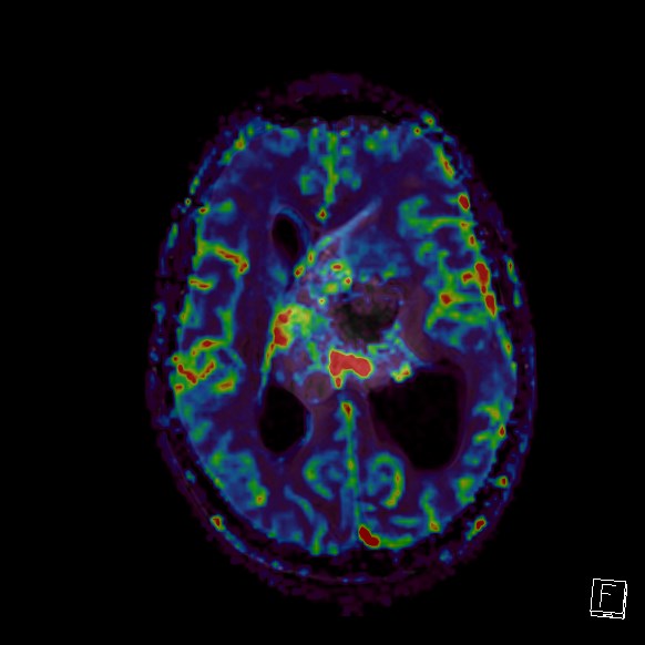 Central neurocytoma (Radiopaedia 84497-99872 Axial Perfusion 138).jpg