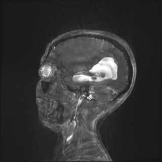Central neurocytoma (Radiopaedia 84497-99872 Sagittal CISS 1).jpg
