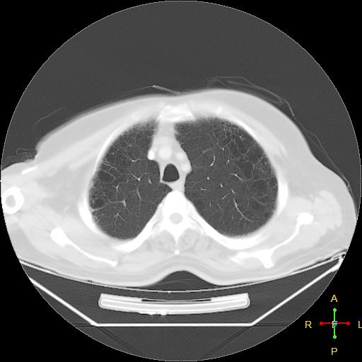 File:Centrilobular emphysema - with superimposed infection (Radiopaedia 24389-24683 lung window 6).jpg