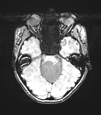 Cerebellar agenesis with hypoplastic pons (pontocerebellar hypoplasia) (Radiopaedia 57224-64138 Axial SWI 31).png