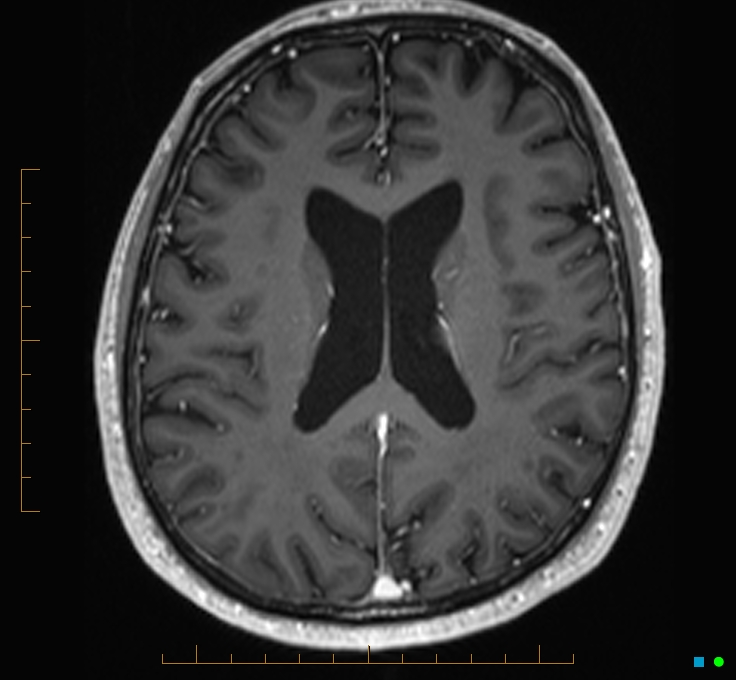 Cerebellar gangliocytoma (Radiopaedia 65377-74422 Axial T1 C+ 82).jpg