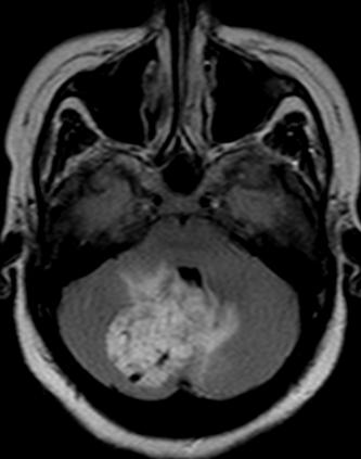 File:Cerebellar hemangioblastoma (Radiopaedia 10779-11234 Axial FLAIR 1).JPG