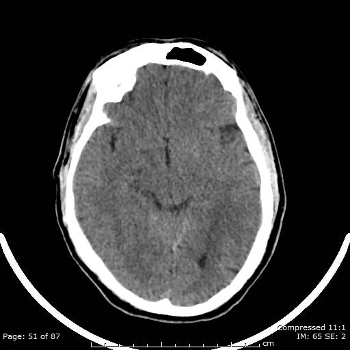 Cerebellar hemangioblastoma (Radiopaedia 52360-58258 Axial non-contrast 51).jpg