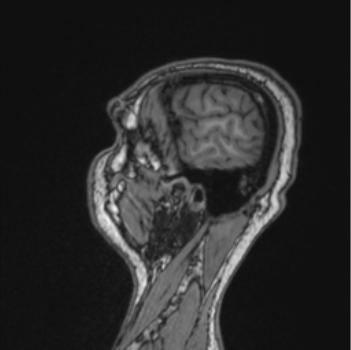 Cerebellar hemangioblastomas and pituitary adenoma (Radiopaedia 85490-101176 Sagittal T1 25).png