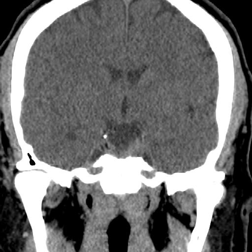 Cerebellar infarction (Radiopaedia 16625-16327 Coronal non-contrast 5).jpg