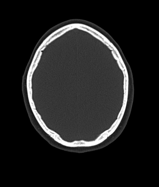 File:Cerebellar metastases - colorectal adenocarcinoma (Radiopaedia 40947-43652 AX Bone C- 2.0 MPR 49).png