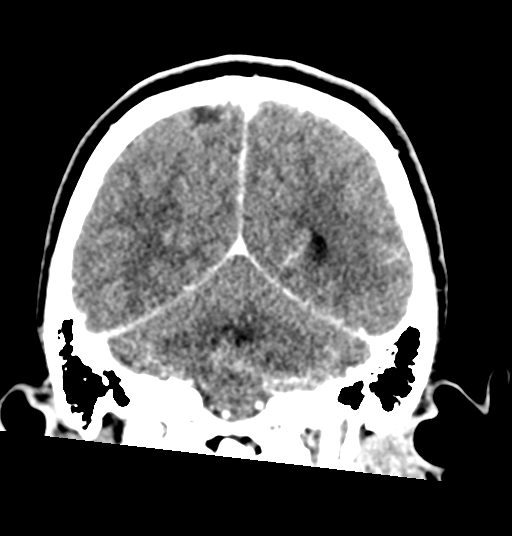 Cerebellar metastases - colorectal adenocarcinoma (Radiopaedia 40947-43652 Coronal C+ 66).png