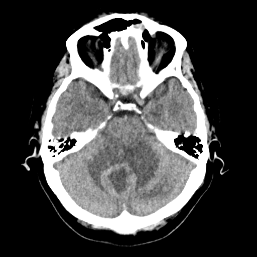 Cerebellar metastasis (Radiopaedia 54578-60812 Axial non-contrast 15).png