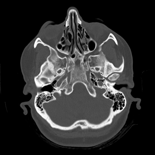 Cerebellar metastasis (cystic appearance) (Radiopaedia 41395-44258 Axial bone window 11).png