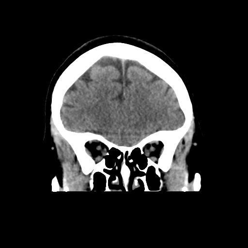 Cerebellar metastasis (cystic appearance) (Radiopaedia 41395-44258 Coronal non-contrast 18).png