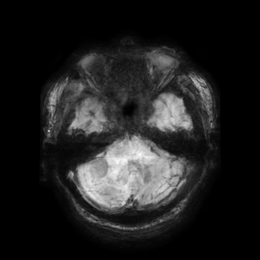 Cerebellar metastasis of pulmonary adenocarcinoma, cavernous venous malformation, and developmental venous anomaly (Radiopaedia 85827-101661 Axial SWI 52).jpg