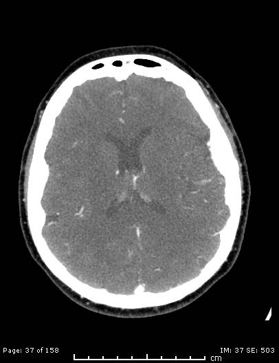 File:Cerebellar strokes due to intracranial giant cell arteritis (Radiopaedia 68799-78510 CT angiogram 37).jpg