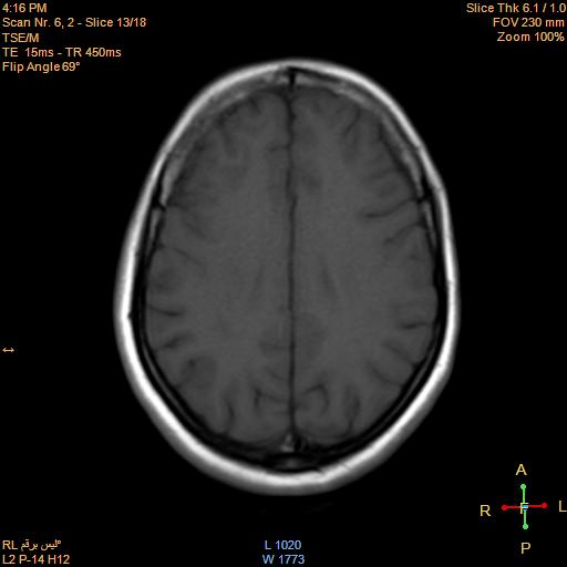 File:Cerebellopontine angle meningioma (Radiopaedia 22488-22525 Axial T1 12).jpg