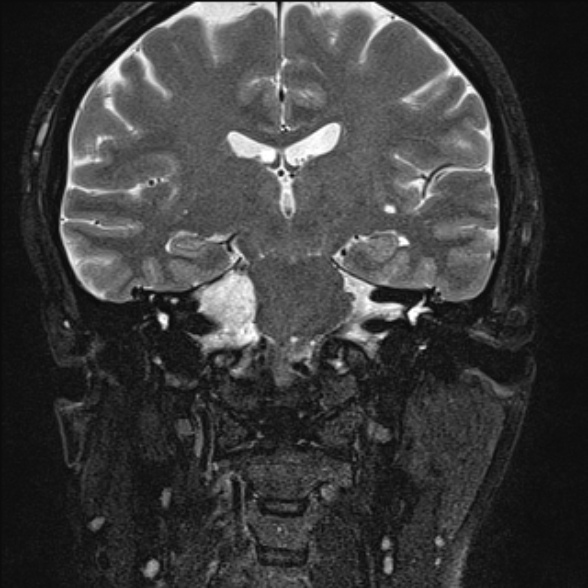 File:Cerebellopontine angle meningioma (Radiopaedia 53561-59591 Coronal T2 12).jpg