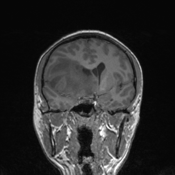 Cerebral abscess (Radiopaedia 24212-24478 Coronal T1 96).jpg