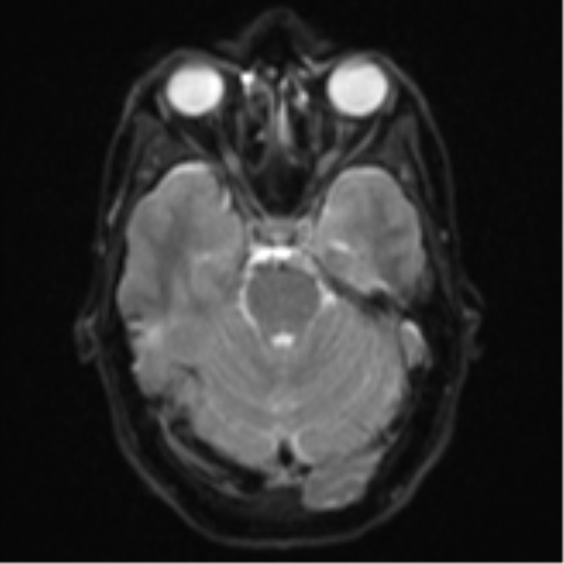 Cerebral abscess (Radiopaedia 60342-68009 Axial DWI 11).png