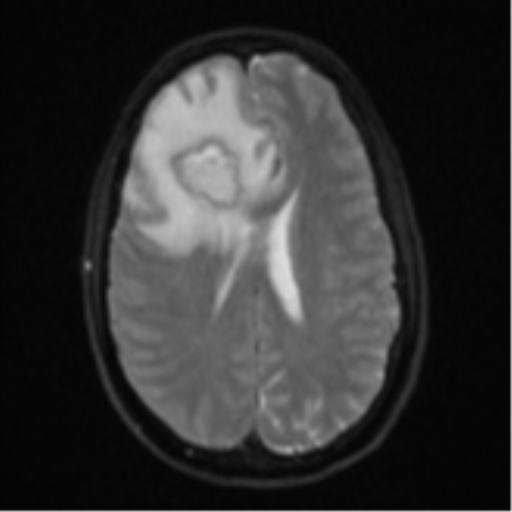 Cerebral abscess (Radiopaedia 60342-68009 Axial DWI 23).png
