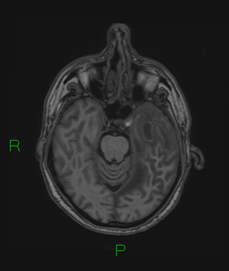 Cerebral abscess and subdural empyema (Radiopaedia 84436-99779 Axial T1 57).jpg