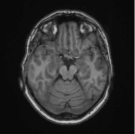 Cerebral abscess from pulmonary arteriovenous malformation (Radiopaedia 86275-102291 Axial T1 30).png