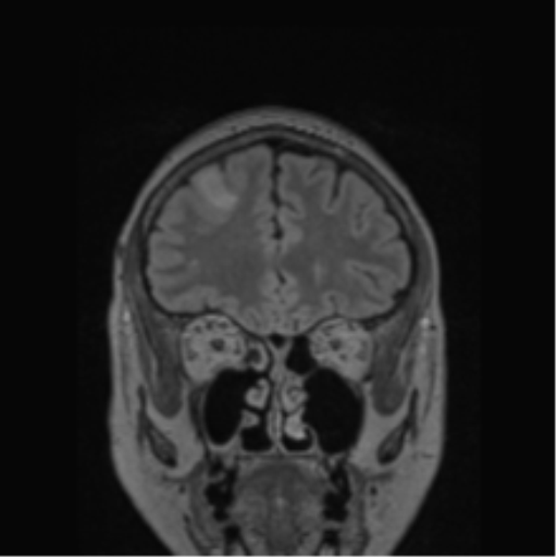 Cerebral abscess from pulmonary arteriovenous malformation (Radiopaedia 86275-102291 Coronal FLAIR 68).png
