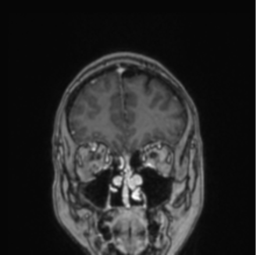 File:Cerebral abscess from pulmonary arteriovenous malformation (Radiopaedia 86275-102291 L 71).png