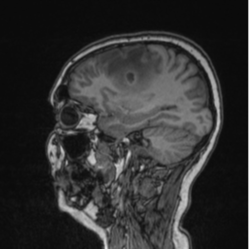 Cerebral abscess from pulmonary arteriovenous malformation (Radiopaedia 86275-102291 Sagittal T1 66).png