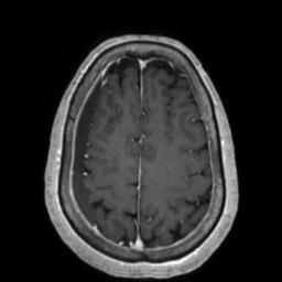 Cerebral amyloid angiopathy (Radiopaedia 29129-29518 Axial T1 C+ 116).jpg
