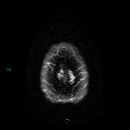Cerebral amyloid angiopathy (Radiopaedia 77506-89664 Axial DWI 56).jpg