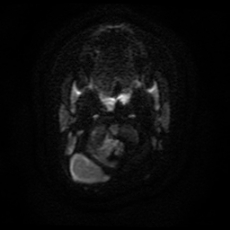 File:Cerebral and spinal tuberculosis (Radiopaedia 90489-107837 Axial DWI 1).jpg