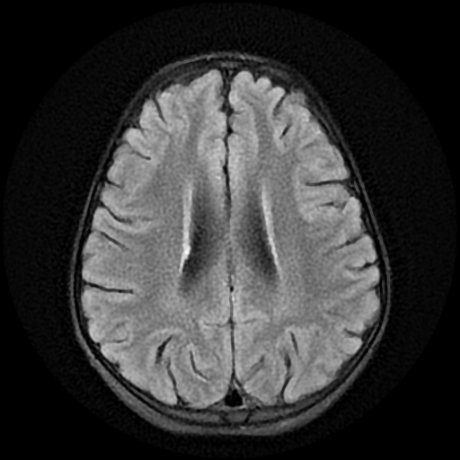 File:Cerebral and spinal tuberculosis (Radiopaedia 90489-107837 Axial FLAIR 15).jpg