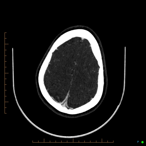 Cerebral arteriovenous malformation (AVM) (Radiopaedia 78162-90706 Axial CTA 226).jpg
