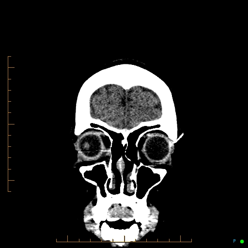 Cerebral arteriovenous malformation (AVM) (Radiopaedia 78162-90706 Coronal non-contrast 14).jpg