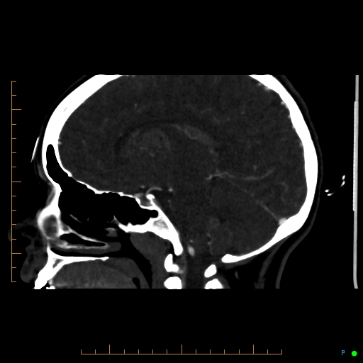 File:Cerebral arteriovenous malformation (AVM) (Radiopaedia 78162-90706 Sagittal CTA 37).jpg