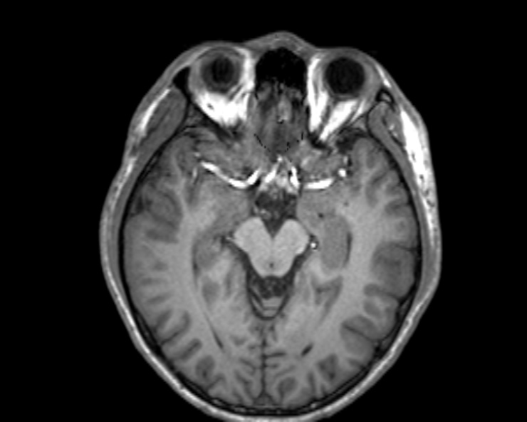 Cerebral arteriovenous malformation (Radiopaedia 30198-30813 Axial T1 37).jpg