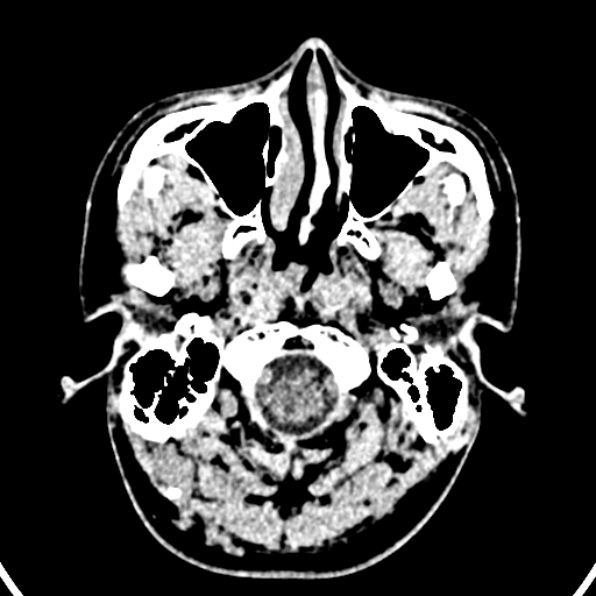 Cerebral arteriovenous malformation (Radiopaedia 37182-39012 Axial non-contrast 2).jpg
