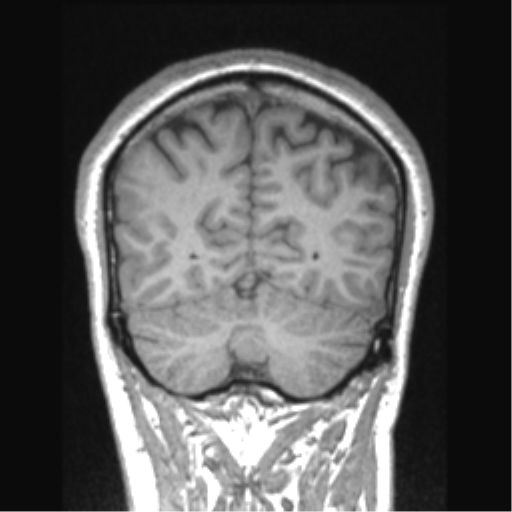 Cerebral arteriovenous malformation (Radiopaedia 39259-41506 Coronal T1 24).png