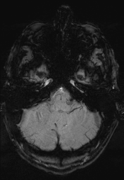 File:Cerebral arteriovenous malformation (Radiopaedia 55798-62372 Axial SWI 7).png
