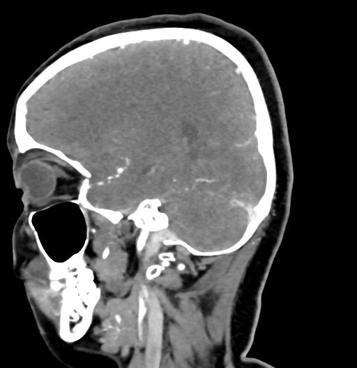 Cerebral arteriovenous malformation (Radiopaedia 73830-84645 D 31).jpg