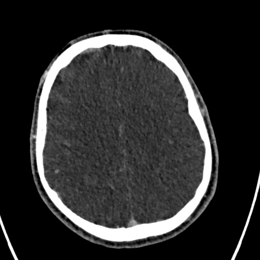 Cerebral arteriovenous malformation (Radiopaedia 78188-90746 Axial C+ delayed 121).jpg