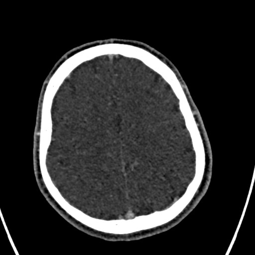 Cerebral arteriovenous malformation (Radiopaedia 78188-90746 Axial C+ delayed 132).jpg