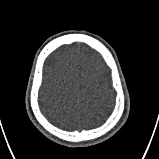 Cerebral arteriovenous malformation (Radiopaedia 78188-90746 Axial non-contrast 149).jpg