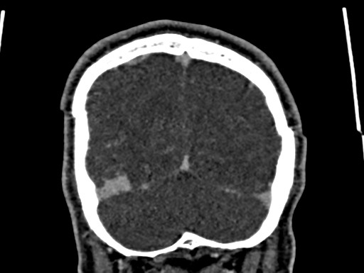 Cerebral arteriovenous malformation (Radiopaedia 78188-90746 Coronal C+ delayed 107).jpg