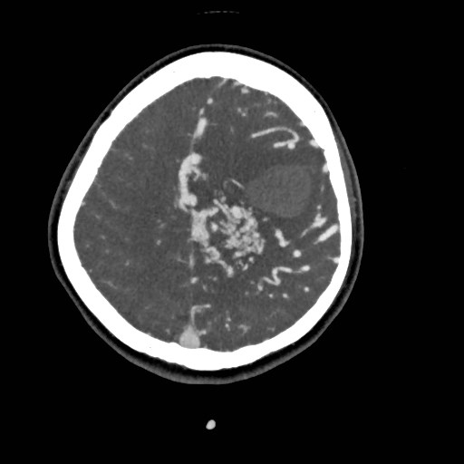 File:Cerebral arteriovenous malformation (Radiopaedia 79677-92888 A 44).jpg