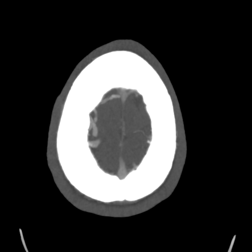 Cerebral arteriovenous malformation (Spetzler-Martin grade 2) (Radiopaedia 41262-44076 E 49).png