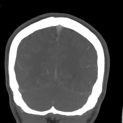 Cerebral arteriovenous malformation (Spetzler-Martin grade 2) (Radiopaedia 41262-44076 F 52).png