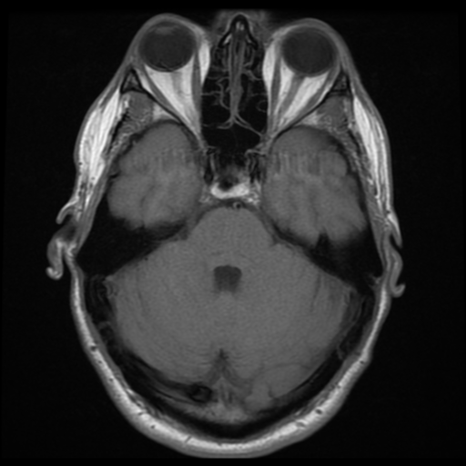 File:Cerebral arteriovenous malformation (Spetzler-Martin grade 2) (Radiopaedia 41262-44092 Axial T1 5).png