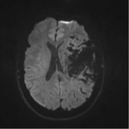 File:Cerebral arteriovenous malformation - huge (Radiopaedia 35734-37272 Axial DWI 37).png