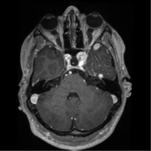 File:Cerebral arteriovenous malformation - huge (Radiopaedia 35734-37272 Axial T1 C+ 18).png