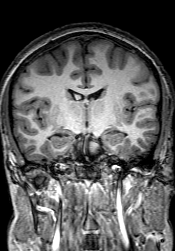 Cerebral arteriovenous malformation at posterior body of corpus callosum (Radiopaedia 74111-84925 Coronal T1 160).jpg