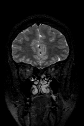 Cerebral arteriovenous malformation at posterior body of corpus callosum (Radiopaedia 74111-84925 Coronal T2 35).jpg